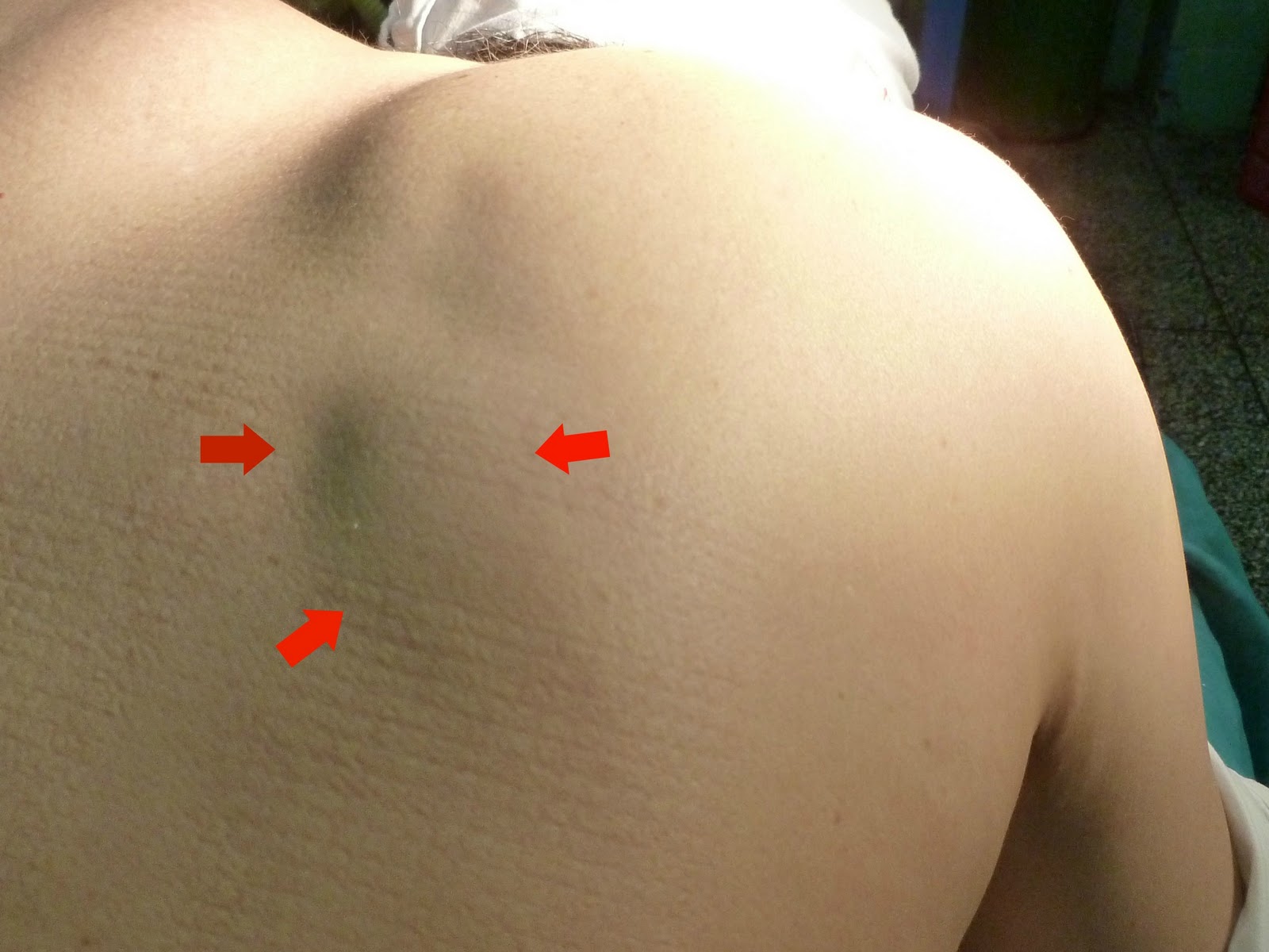 como quitar un lipoma en la cara